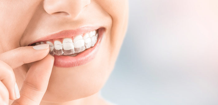 Invisalign in der PAN Klinik bei Ihrem Zahnarzt Köln