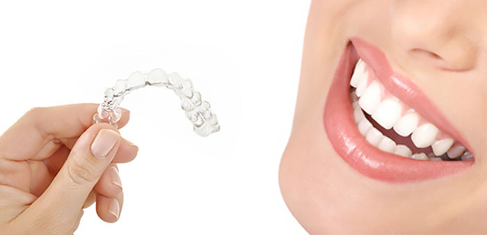 Invisalign Zahnspange für Erwachsene Zahnarzt Köln