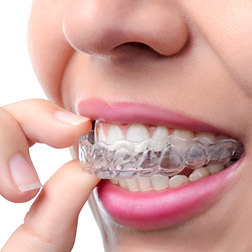 invisalign-zahnarzt-koeln-news